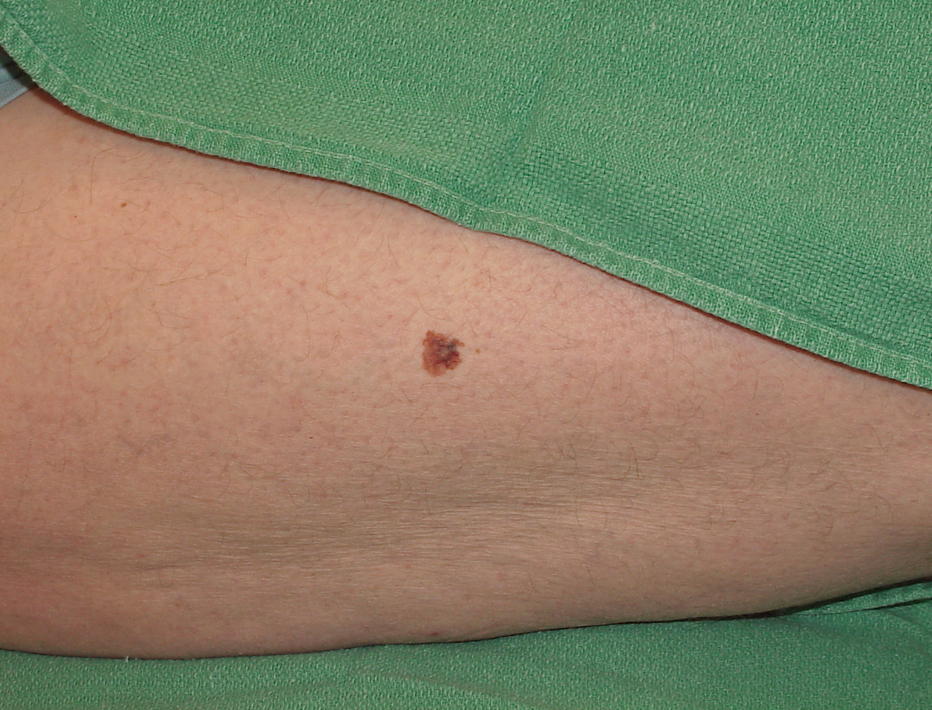 Melanoma Image 10A - Large