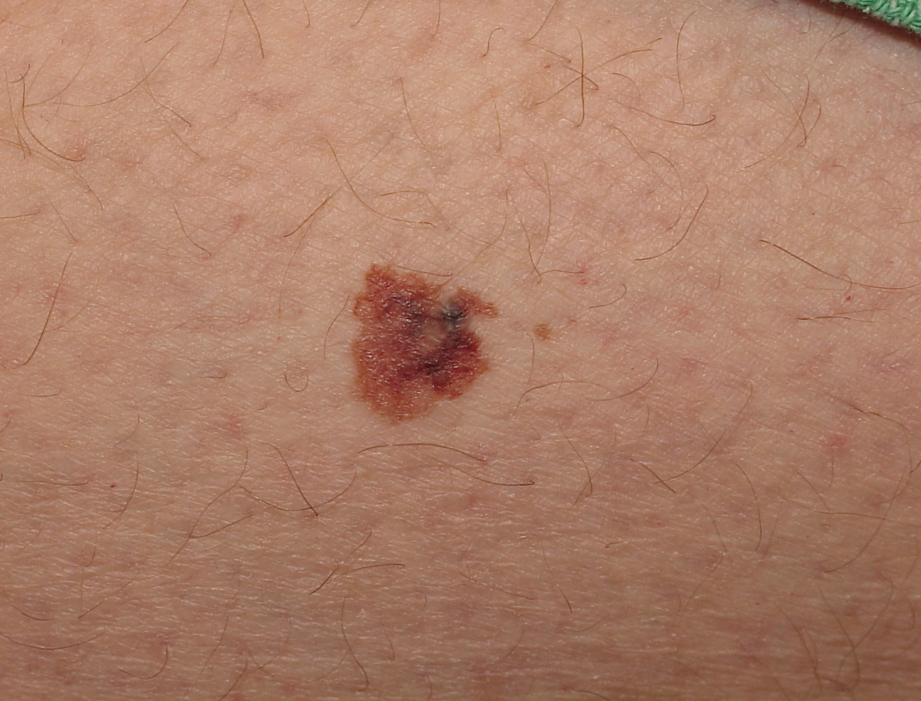 Melanoma Image 10B - Large