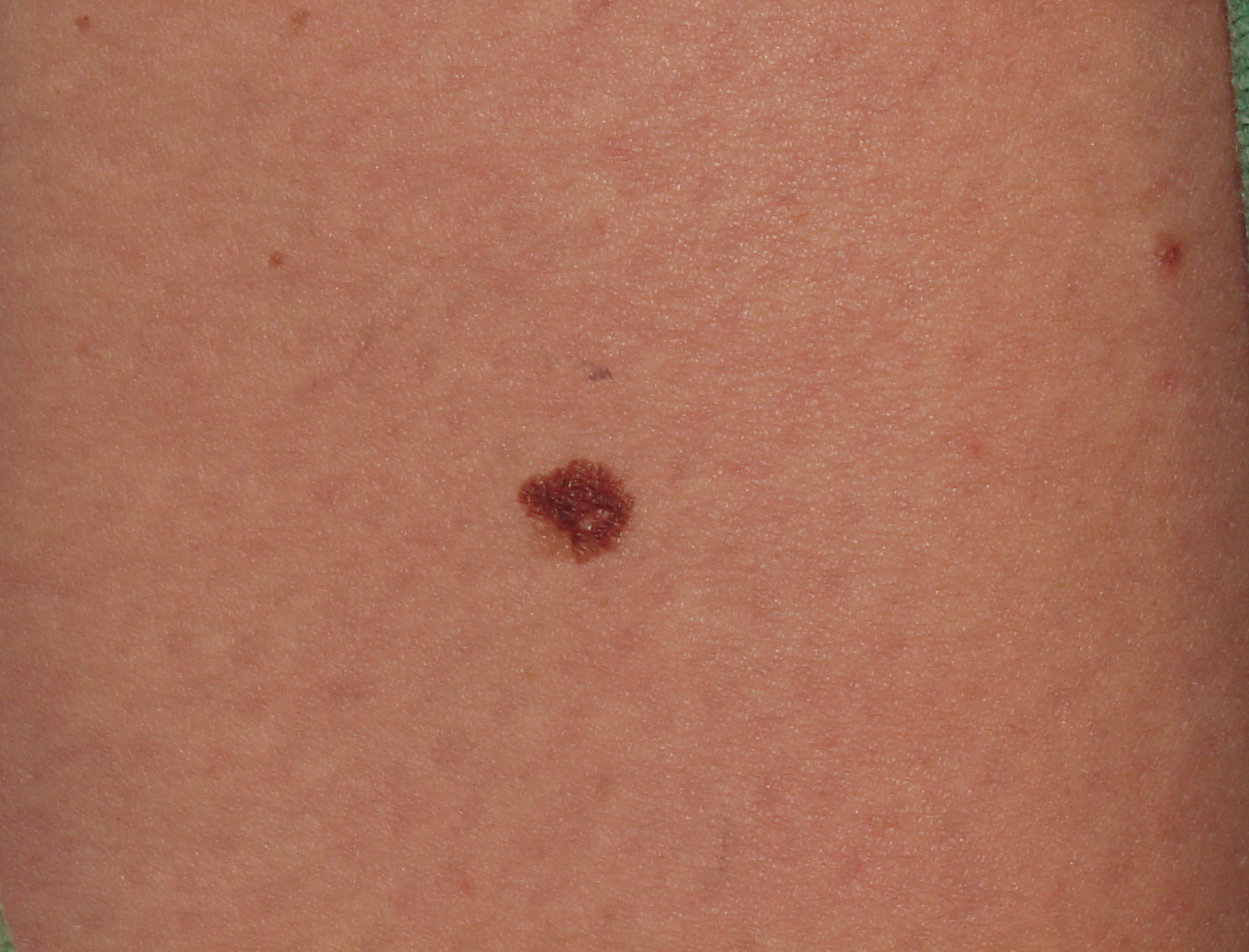 Melanoma Image 15 - Large