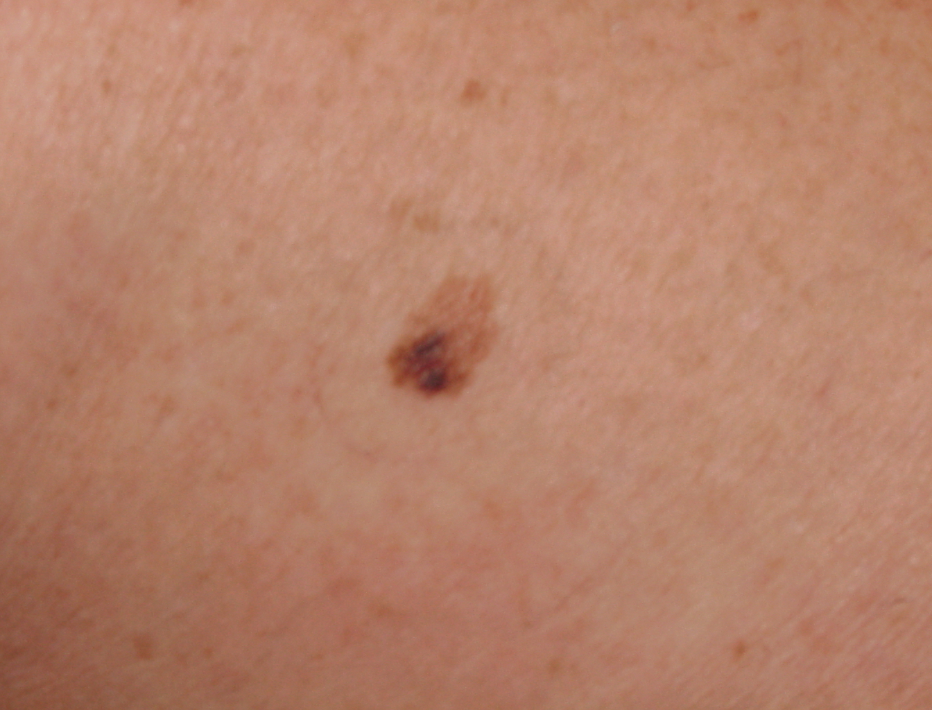 Melanoma Image 3B - Large