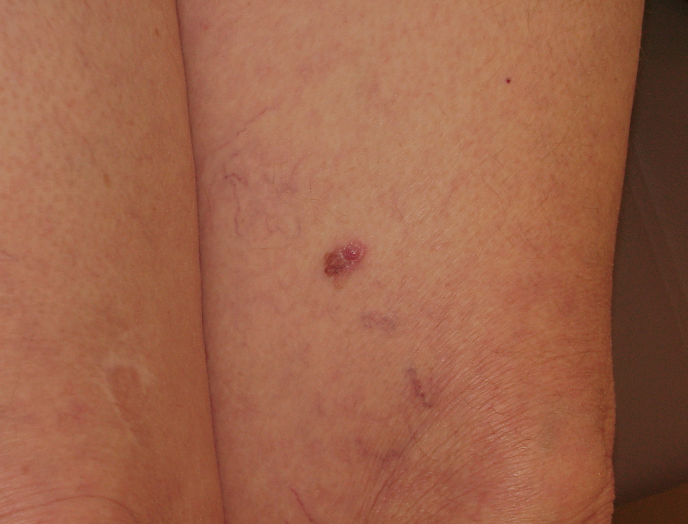 Melanoma Image 8A - Large