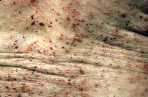 Pediculosis